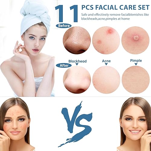Miniatura 2 de Kit de herramientas para eliminar puntos negros, herramienta extractora de espinillas, herramienta extractora de espinillas, herramienta profesional