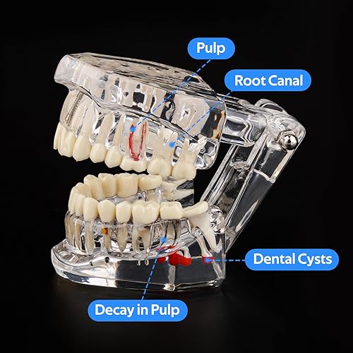 Miniatura 3 de Ultrassist Modelo transparente de dientes de enfermedad con puente de implante dental, modelo dental para la educación del paciente y del estudiante