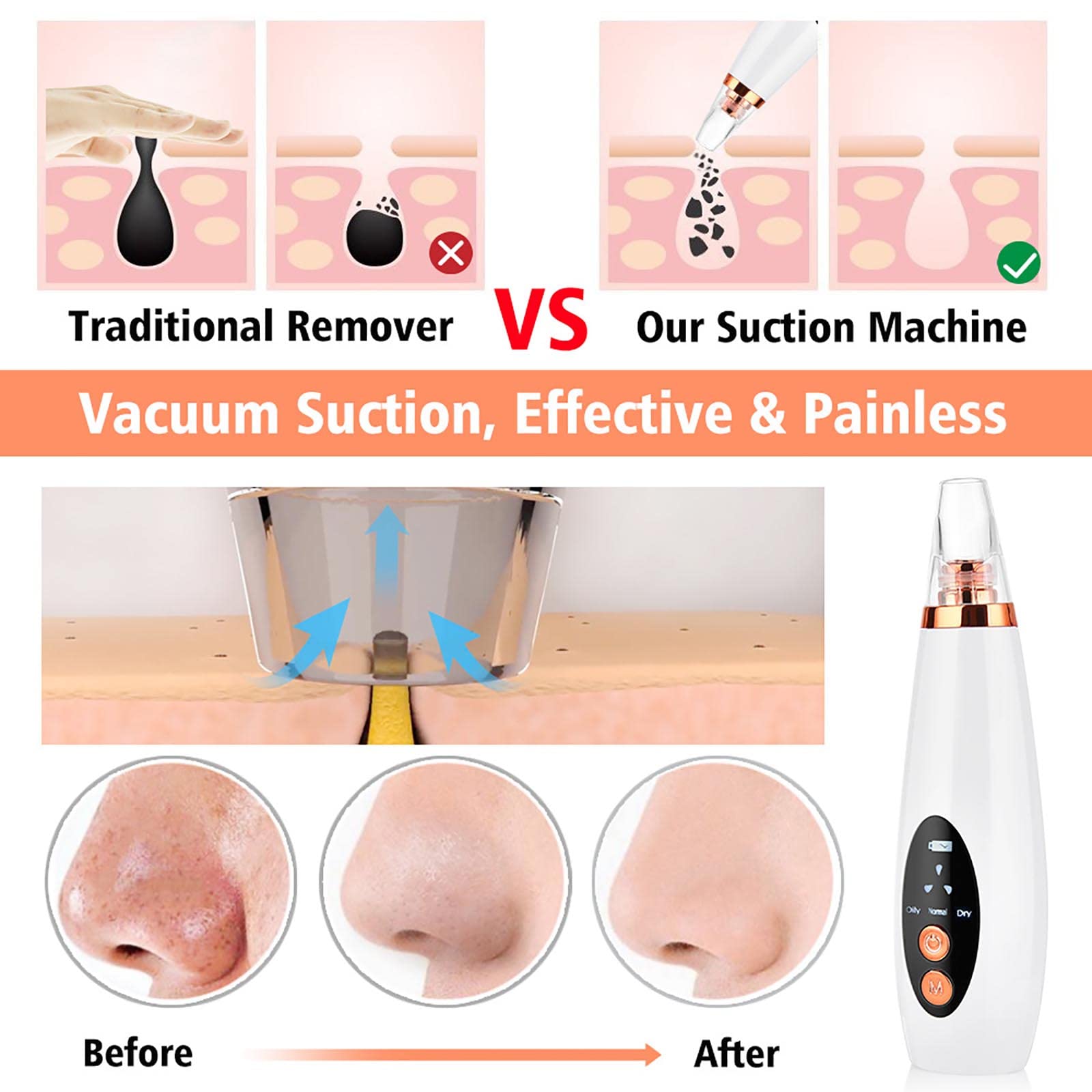 Limpiador facial de poros – Aspirador de poros para eliminar puntos negros, herramienta extractora de puntos blancos de comedones de acné, herramienta de succión de puntos negros, extractor de