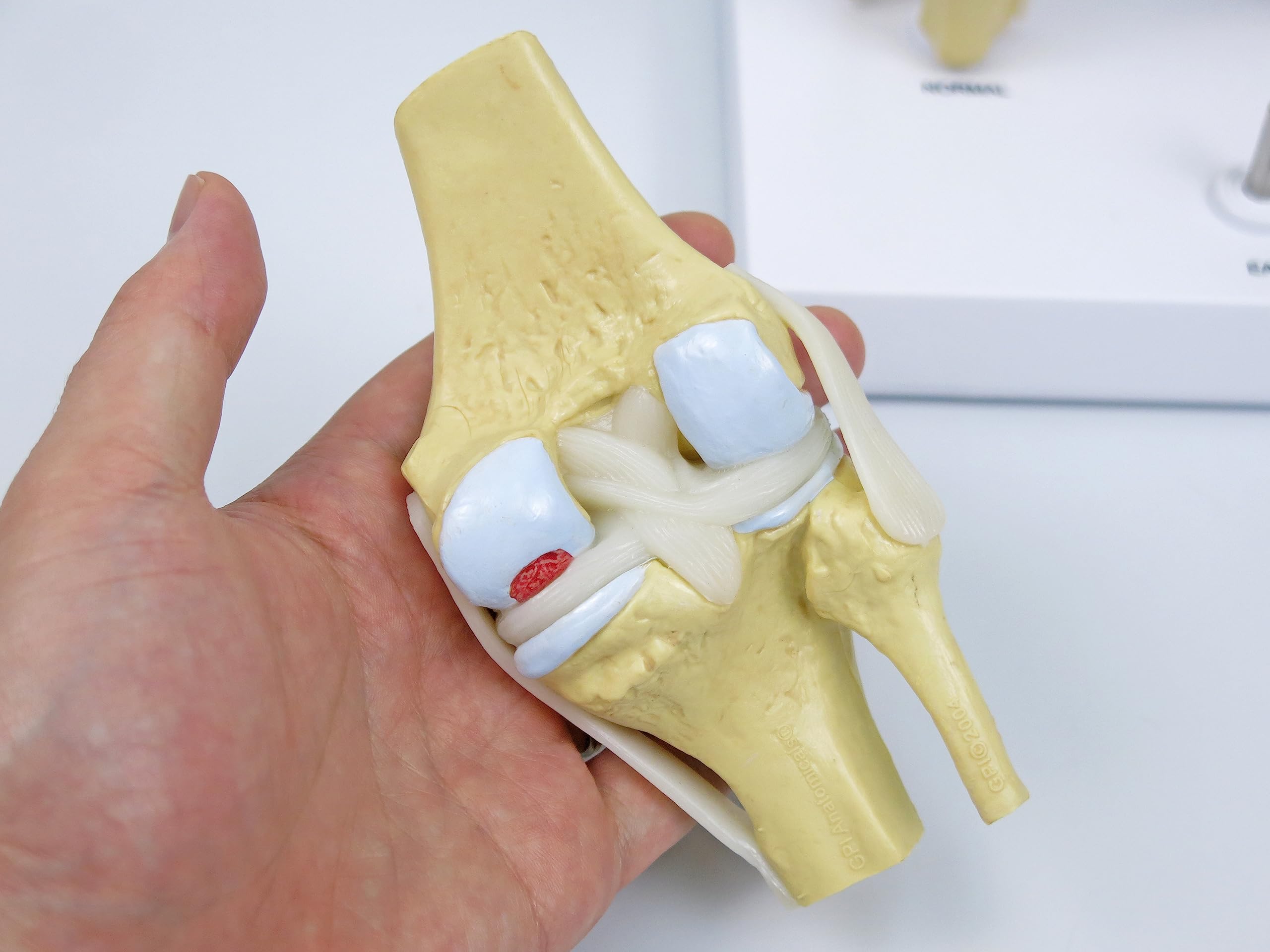 GPI Anatomicals 1100 Osteo-Kniemodellset 4 verschiedener Stadien