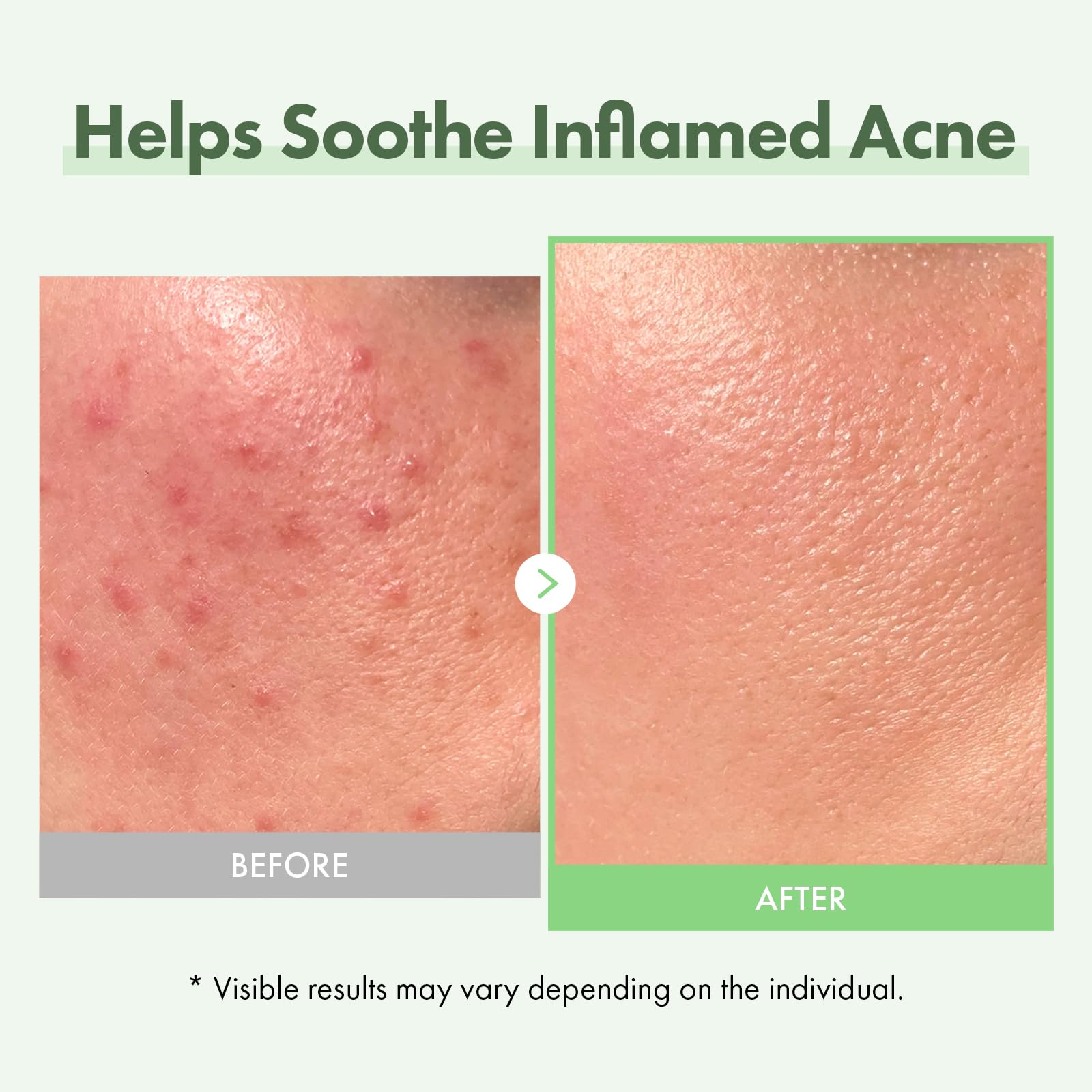 Duo Apaisant & Hydratant : Sérum Visage Acide Azélaïque 10% & Ampoule Real Relief Noni TOSOWOONG pour une Peau Claire et Éclatante