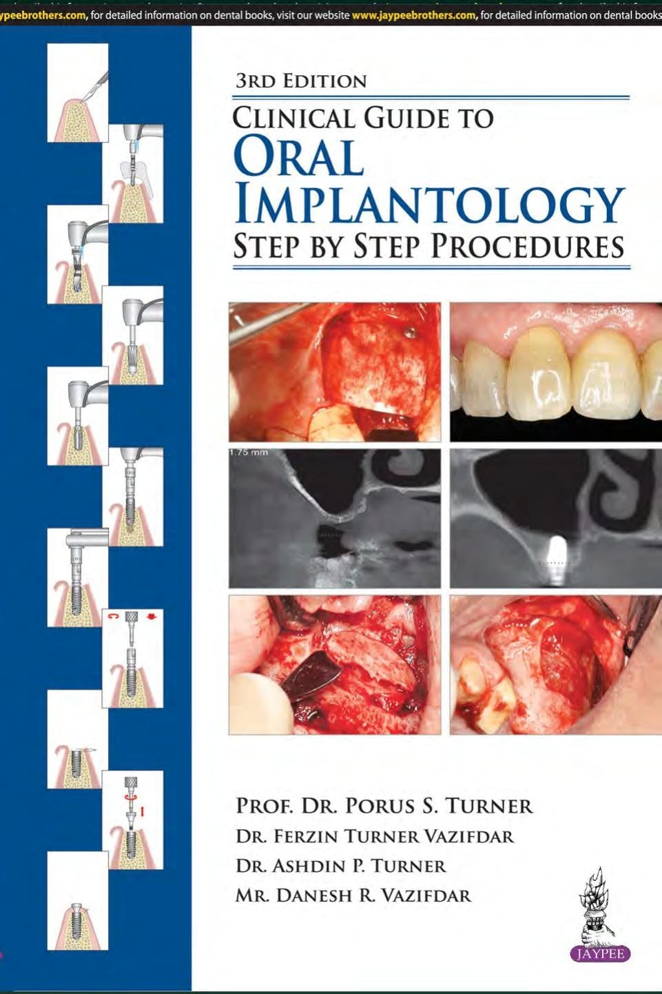 Clinical Guide to Oral Implantology: Step by Step Procedures