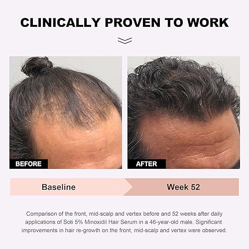 Miniatura 3 de Minoxidil - Suero de crecimiento del cabello al 5%, suero de crecimiento para la pérdida de cabello recomendado por dermatólogos con ginseng y