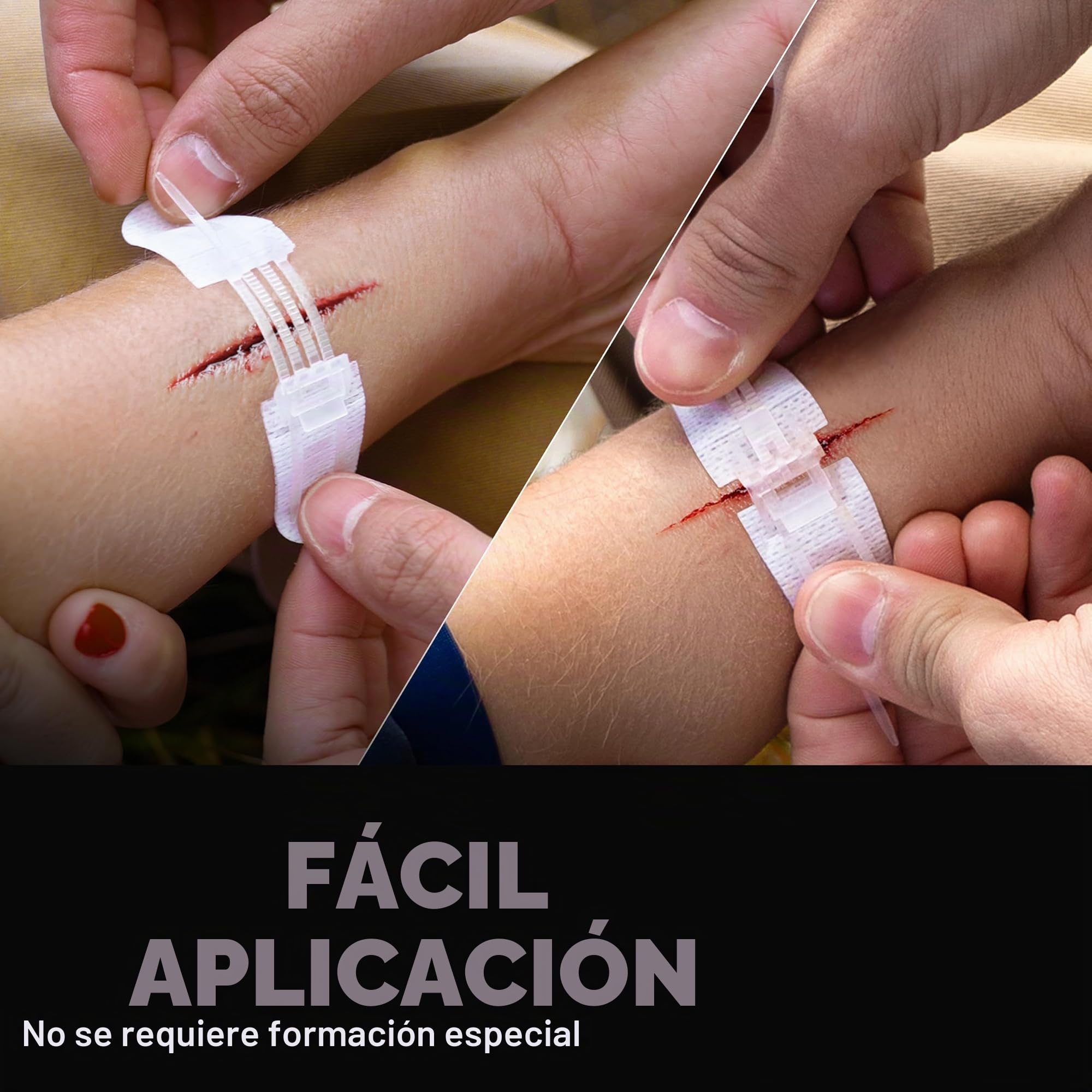 SurviveX Kit de cierre de herida de punto de cremallera, no necesita puntadas | Cerrar heridas sin agujas ni puntadas, no invasivo para usuarios sensibles, fácil de usar, tensión ajustable