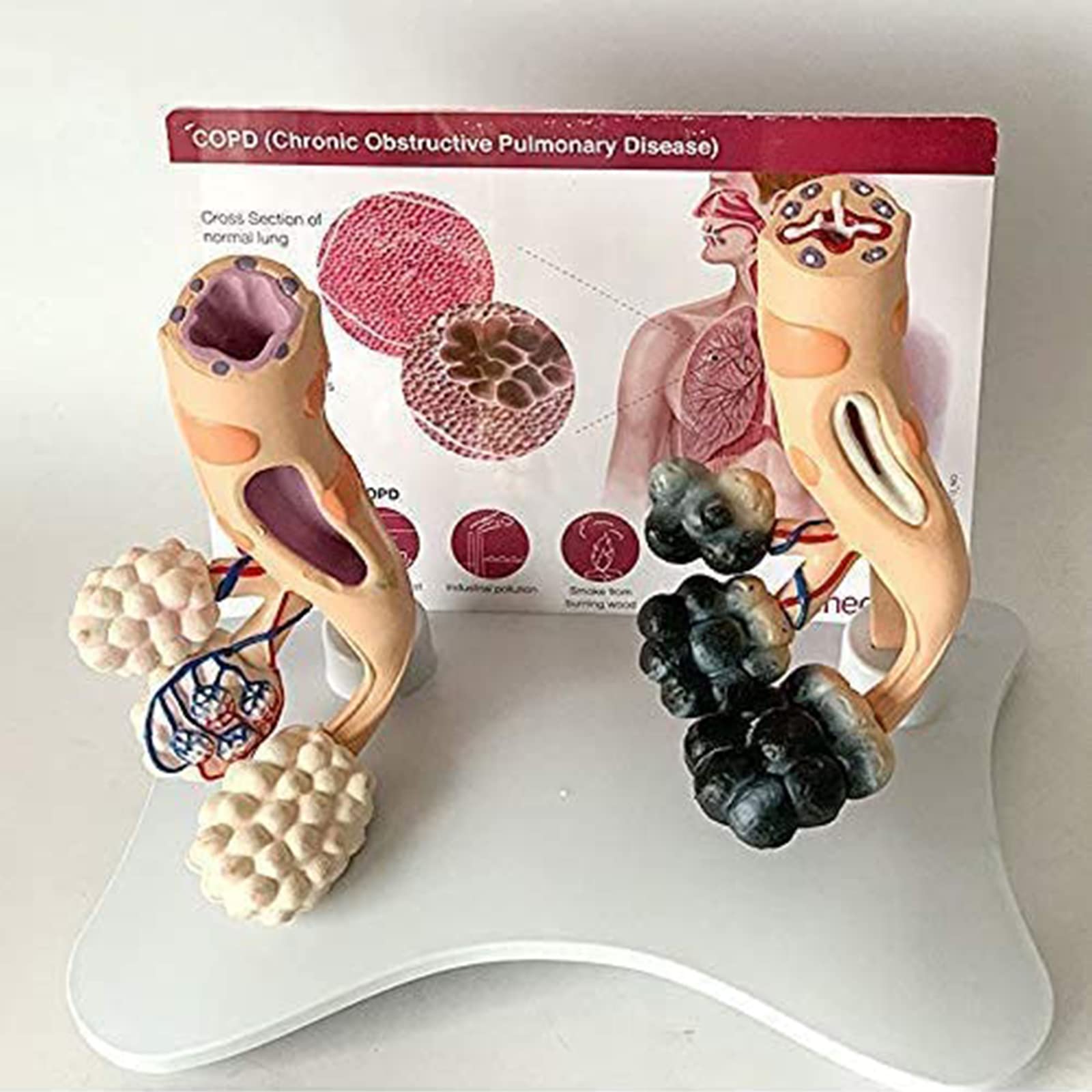 Jfgctyhxy One Color Anatomy Models, Modelhealthy Lung And Pathological Comparison Modelclassroom For Doctor Patient Education Anatomical Model