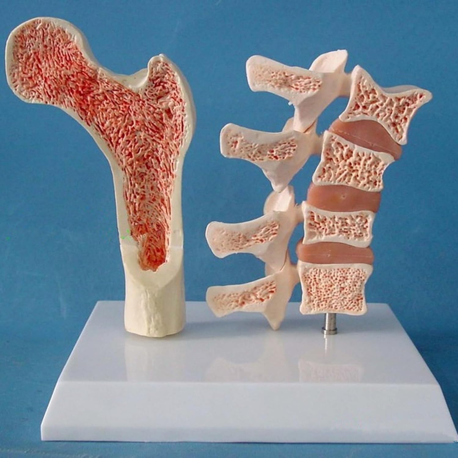 Bone Model osteoporosis Model, osteoporosis Model, Human Spine Anatomy Model for Teaching Demonstration, with Learning Cards