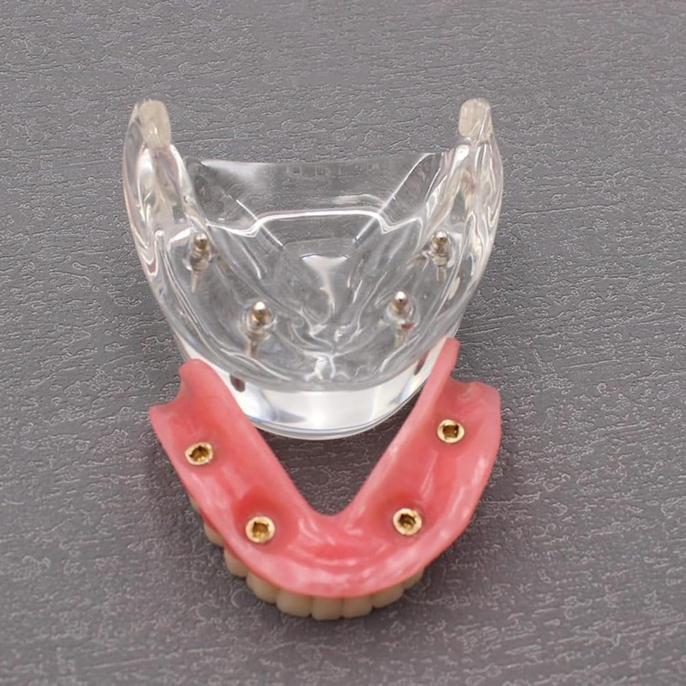 Model zębów implantów dentystycznych Wyczyść opóźnienie 4 Implanty górnej górnej bazy szczękowej do studiowania nauczania