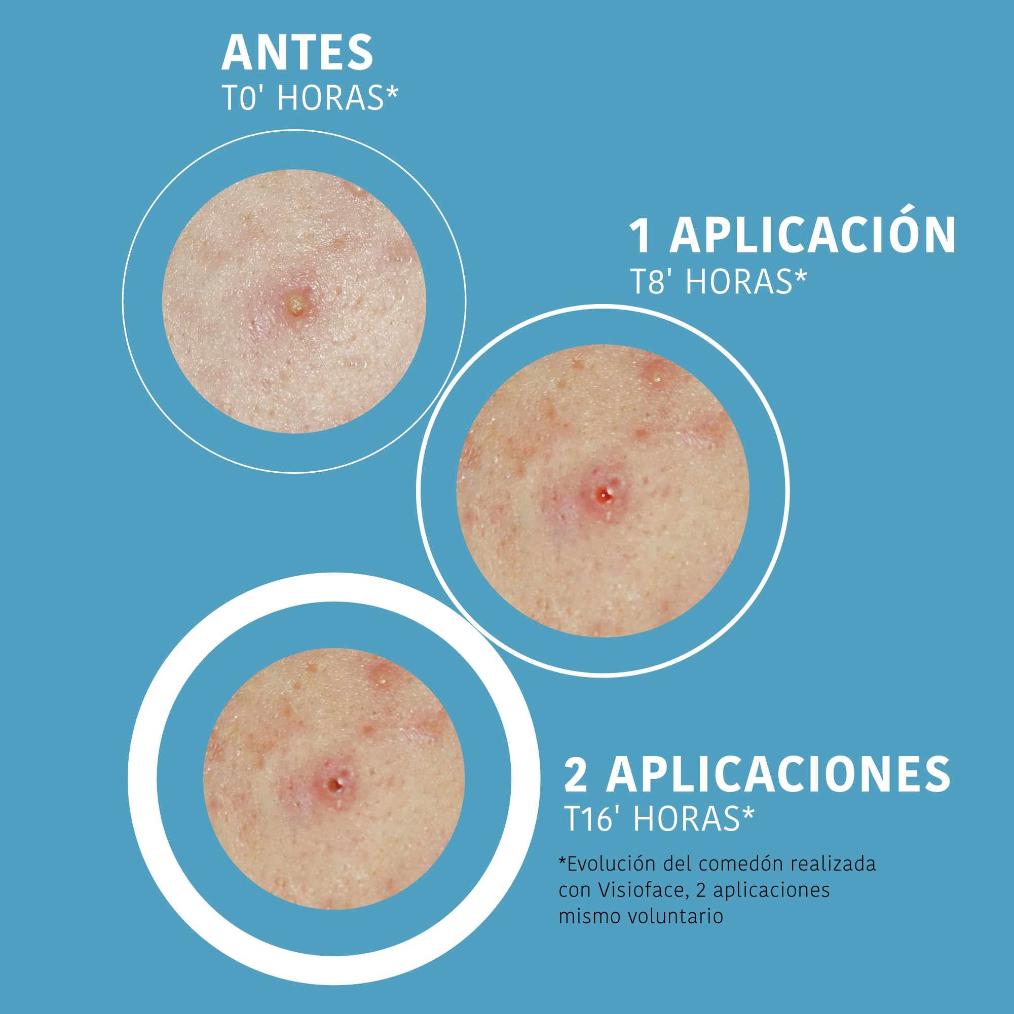 Iroha Nature - Parches para Granos con Ácido Salicílico, Árbol de Té y Centella Asiática, reduce los granos en 8h. Parches para acné (18 unidades). — view 5