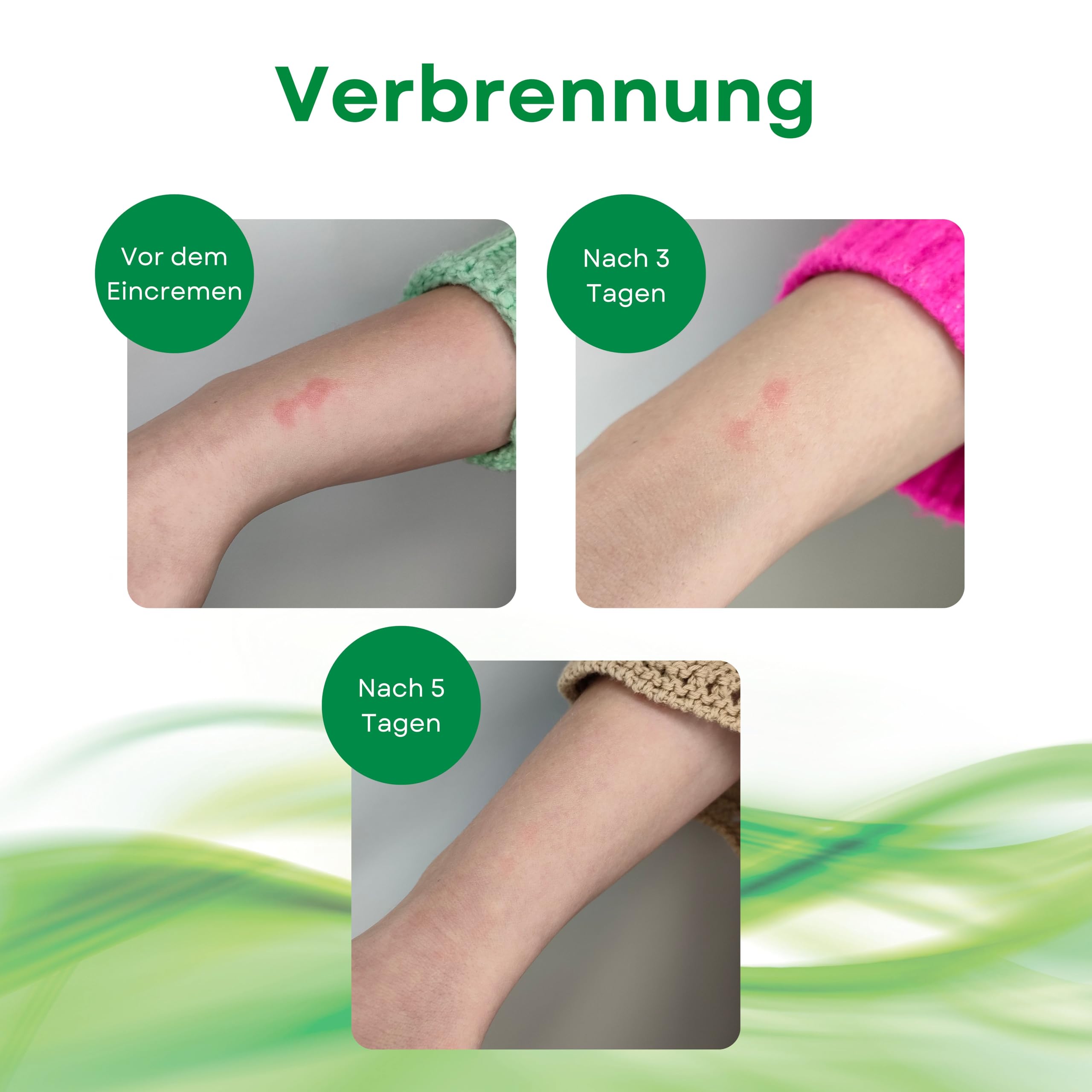 Narbencreme - 30 ml - Aloe Vera-Gel - Schützt empfindliche Haut vor der Sonne - Parabenfrei - Parfümfrei - Hormonfrei - Für alle Hauttypen - Bewährte Wirksamkeit