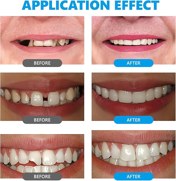 Temporary Tooth Filling, Tooth Filling Repair Kit, Dental Repair Kit for Fixing Missing Broken Teeth(10ml)