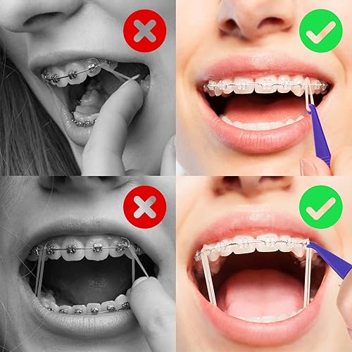 Miniatura 8 de Annhua 20 piezas de bandas elásticas dentales de goma, herramientas de banda de goma, desechables de plástico para bandas de apoyo, multicolor