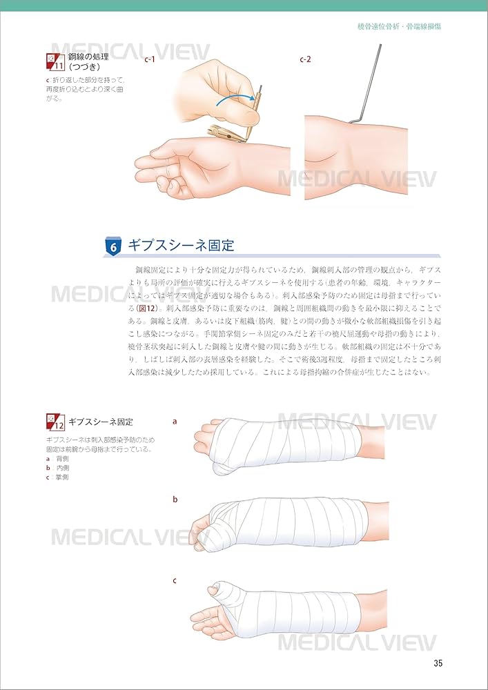 小児の骨折と手術 小児の骨折と手術［Web動画付］ (新OS NEXUS) | 大谷 卓也 |本
