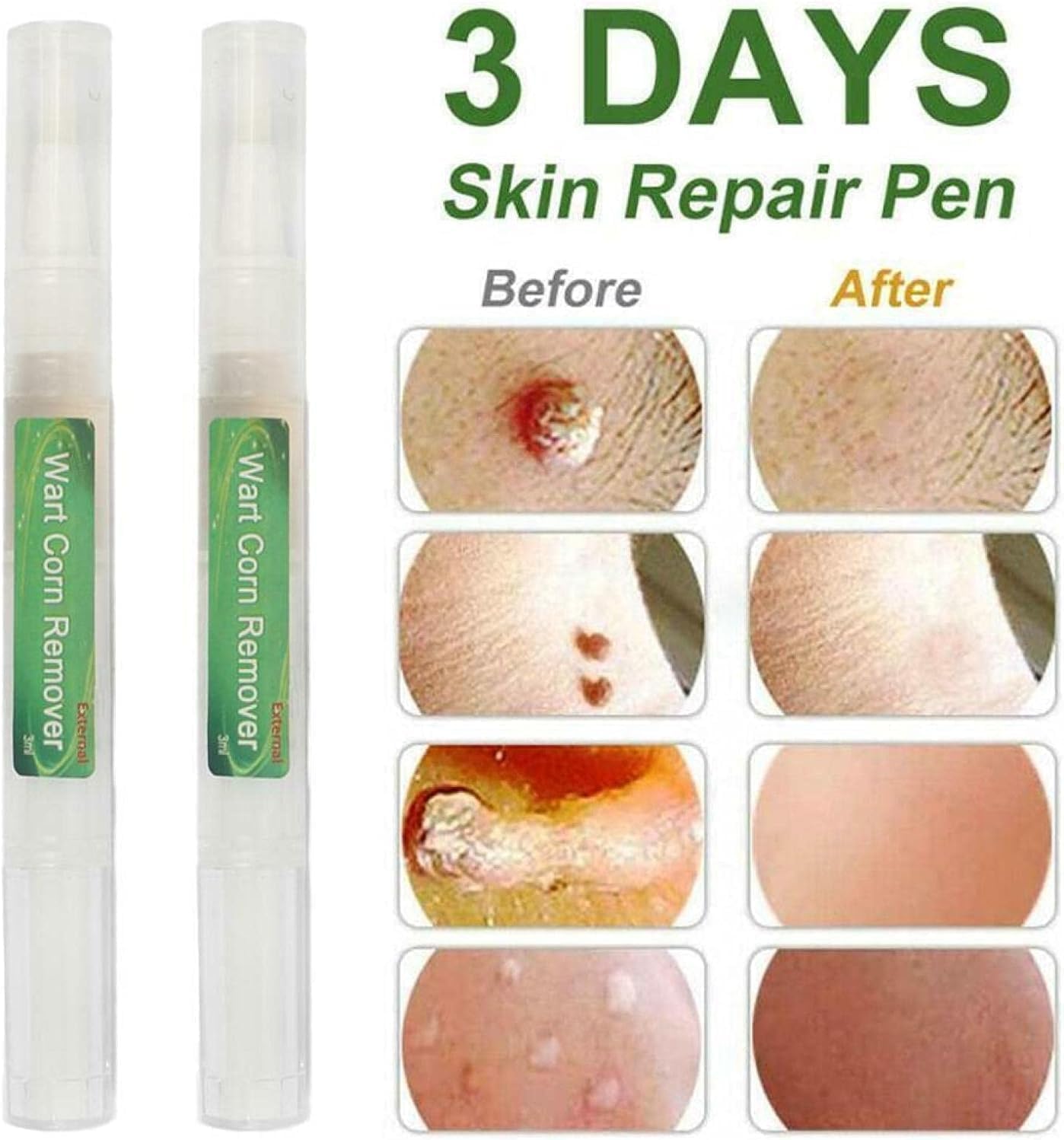 5Pcs Genital Wart ​Treatment Papillomas Removal Warts Liquid Remove Fast Effective Wart Remover Pen 3ml