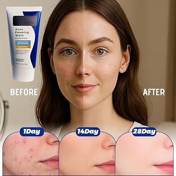Acne Foaming Wash, Face Cleanser for Acne Treatment, Back Acne Body Wash, Daily Facial Cleanser for Back Acne and Face, 156g
