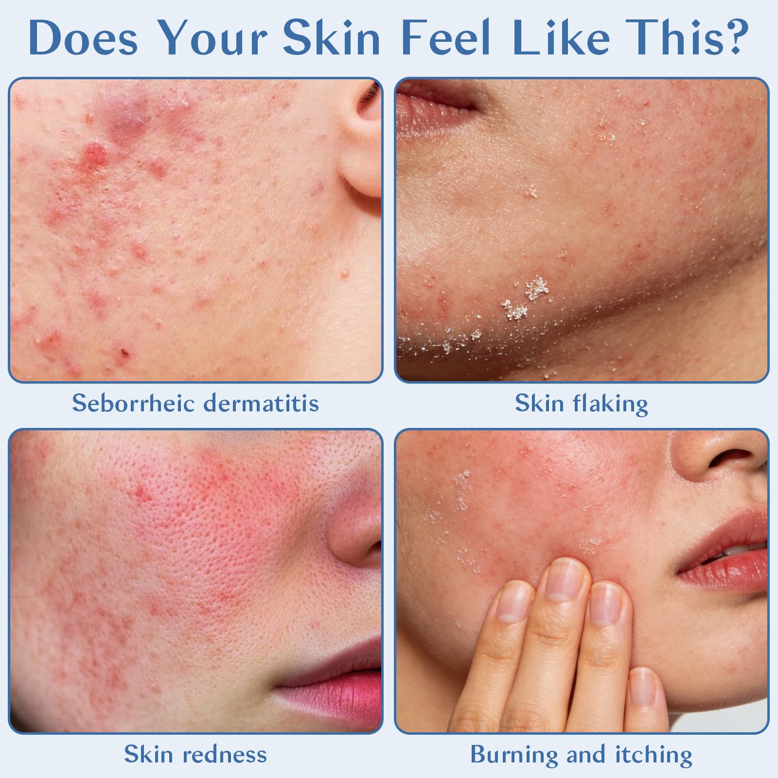 Seborrheic Dermatitis Cream for Face & Scalp with Azelaic Acid
