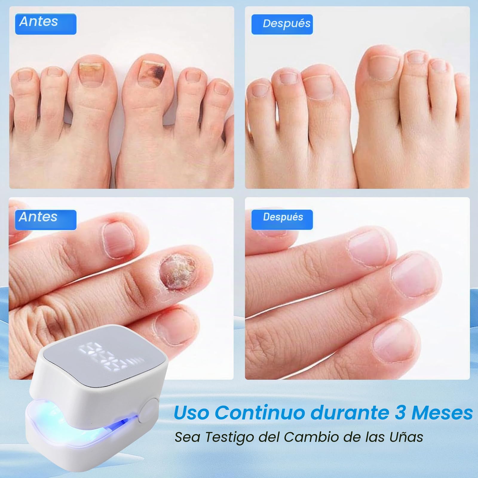 Dispositivo láser para hongos de las uñas de 7 minutos con indicador de tiempo, dispositivo de tratamiento de hongos de las uñas, tratamiento anti-hongos para uñas rápido y efectivo para varios dedos