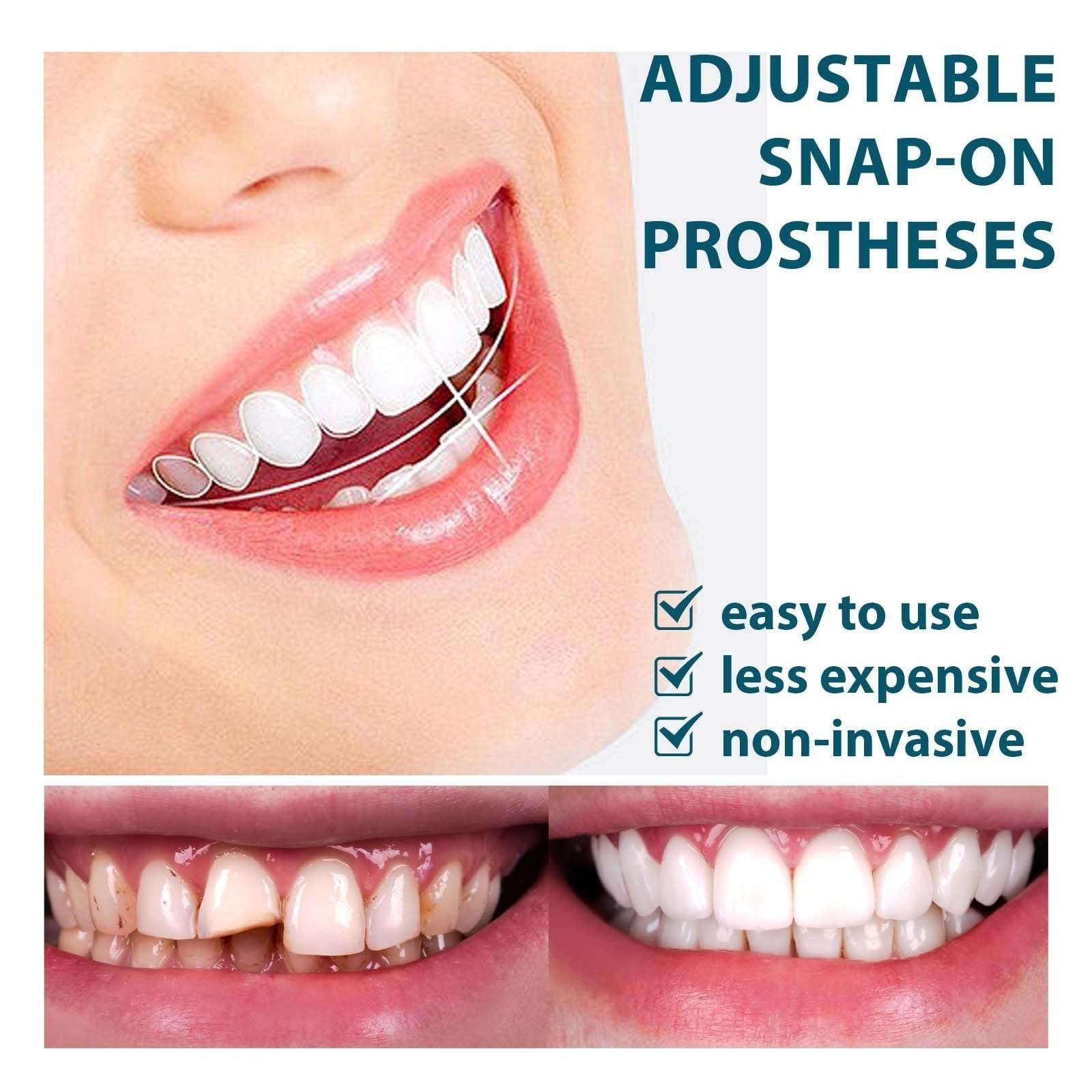 Carillas Dentales Dentidas Temporales, Prótesis Completa Faceta Dental