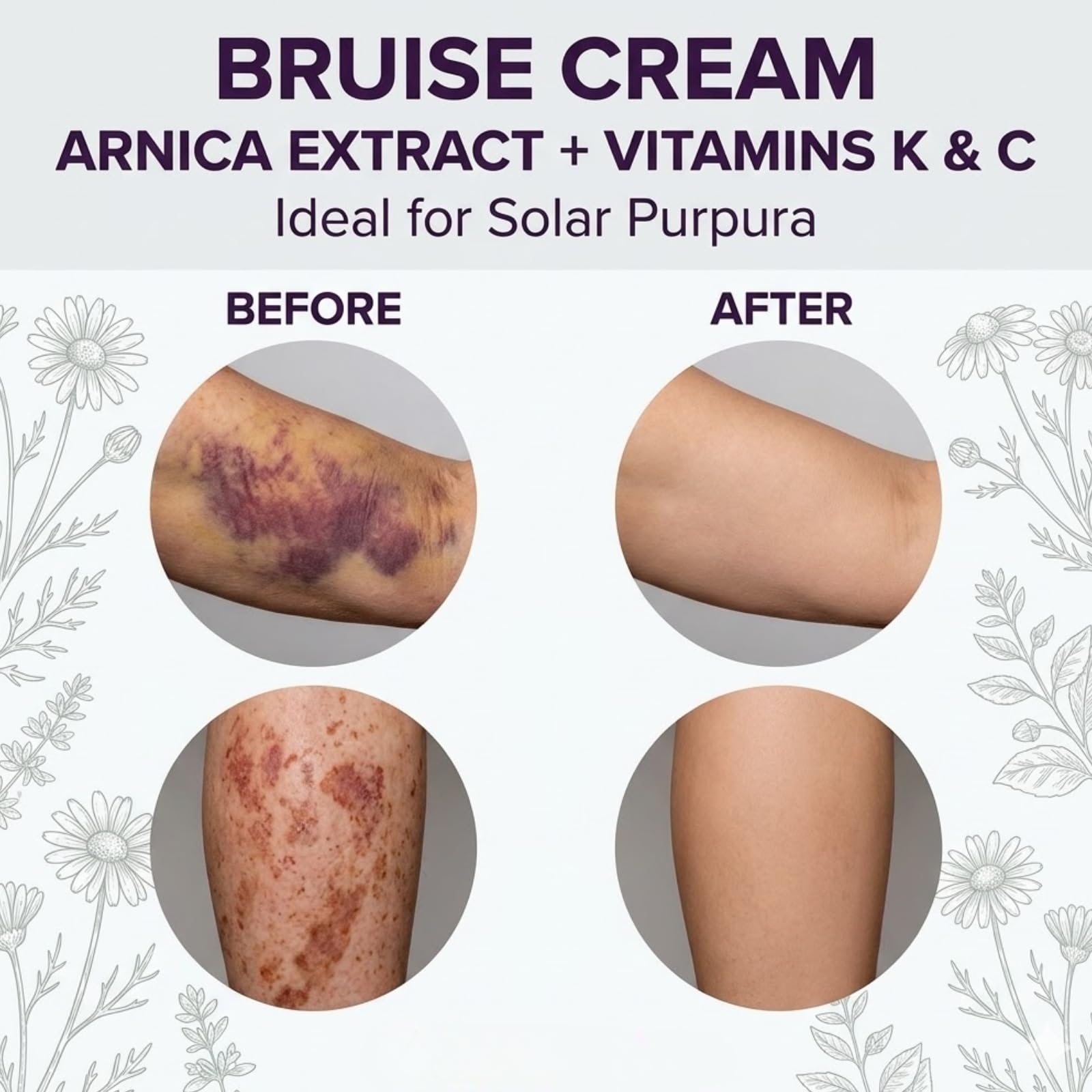 Dermara Bruise Cream with Arnica and Vitamins K, C & E, 4 Oz