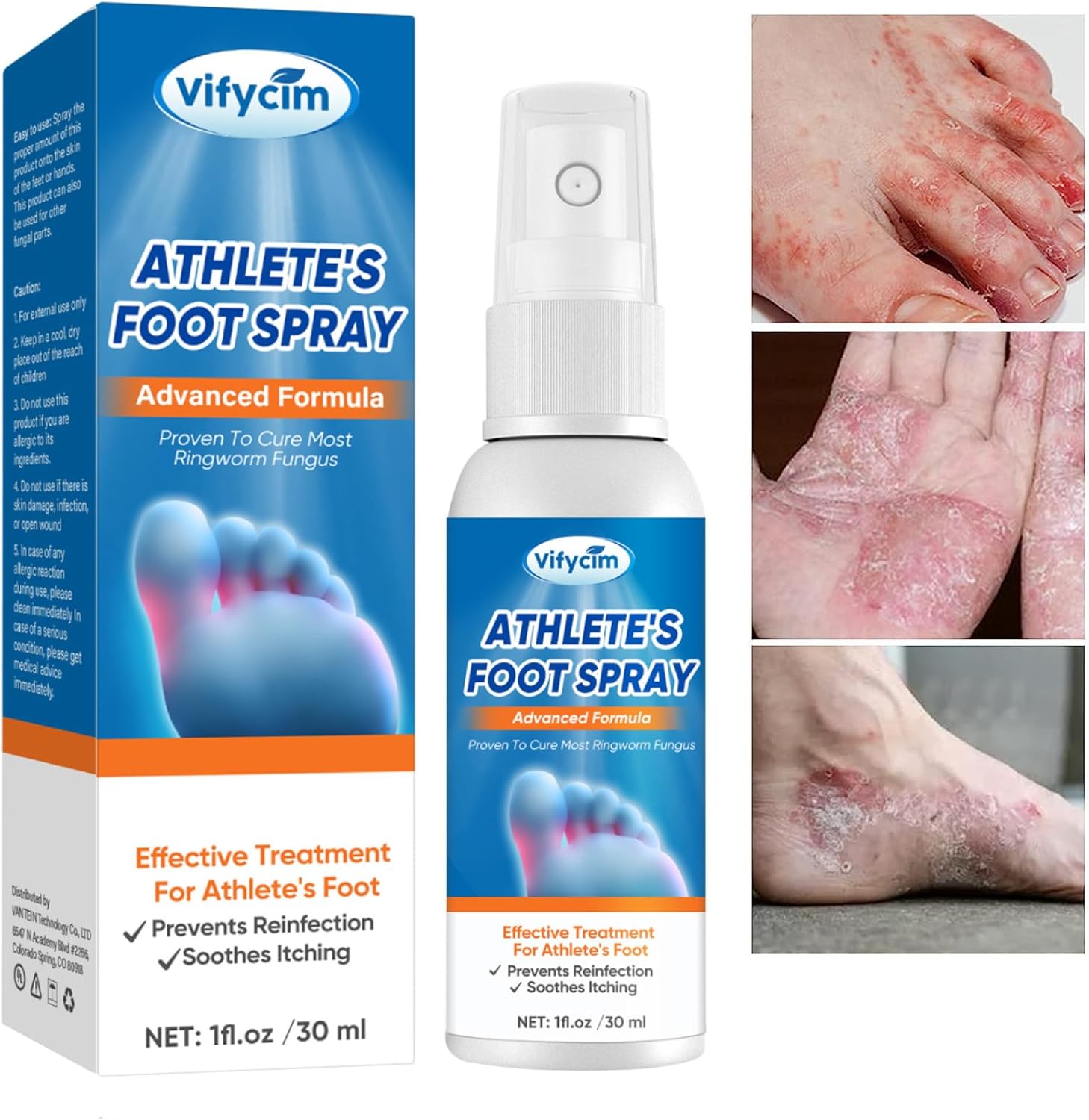 Athletes Foot Treatment Spray AntiFungi Athletes Foot