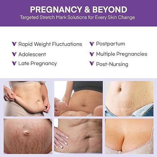 Miniatura 4 de Crema para estrías para el embarazo tratamiento de estrías - Mantequilla de vientre para mujeres embarazadas - Loción de masaje para prevenir y