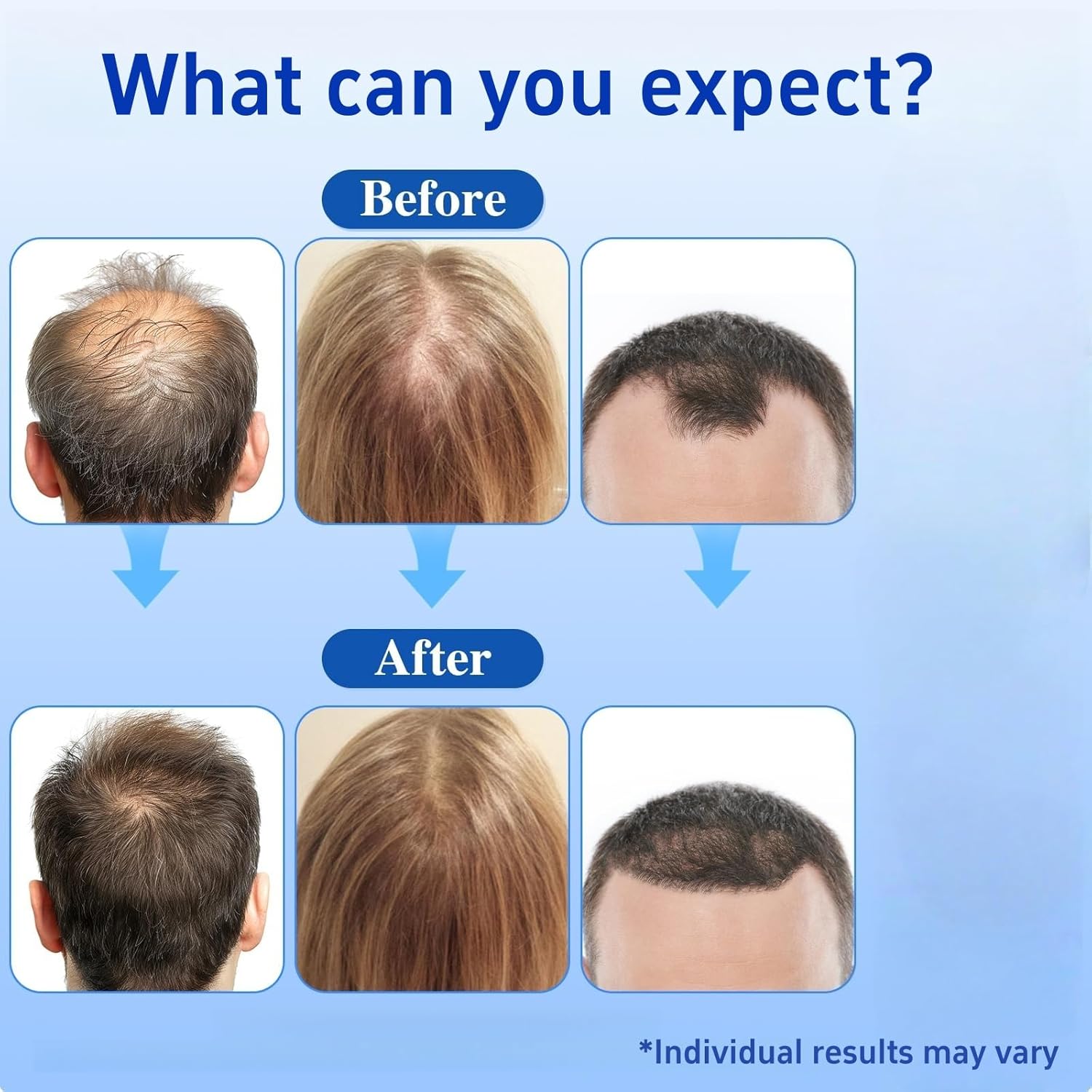 Premium Hair Growth Serum Roll-On with Saw Palmetto, Rosemary & Batana Oil | DHT Blocker with Biotin | Supports Hair | No-Rinse, Fast-Absorbing Formula for Women & Men Pack of 1 - Image 4