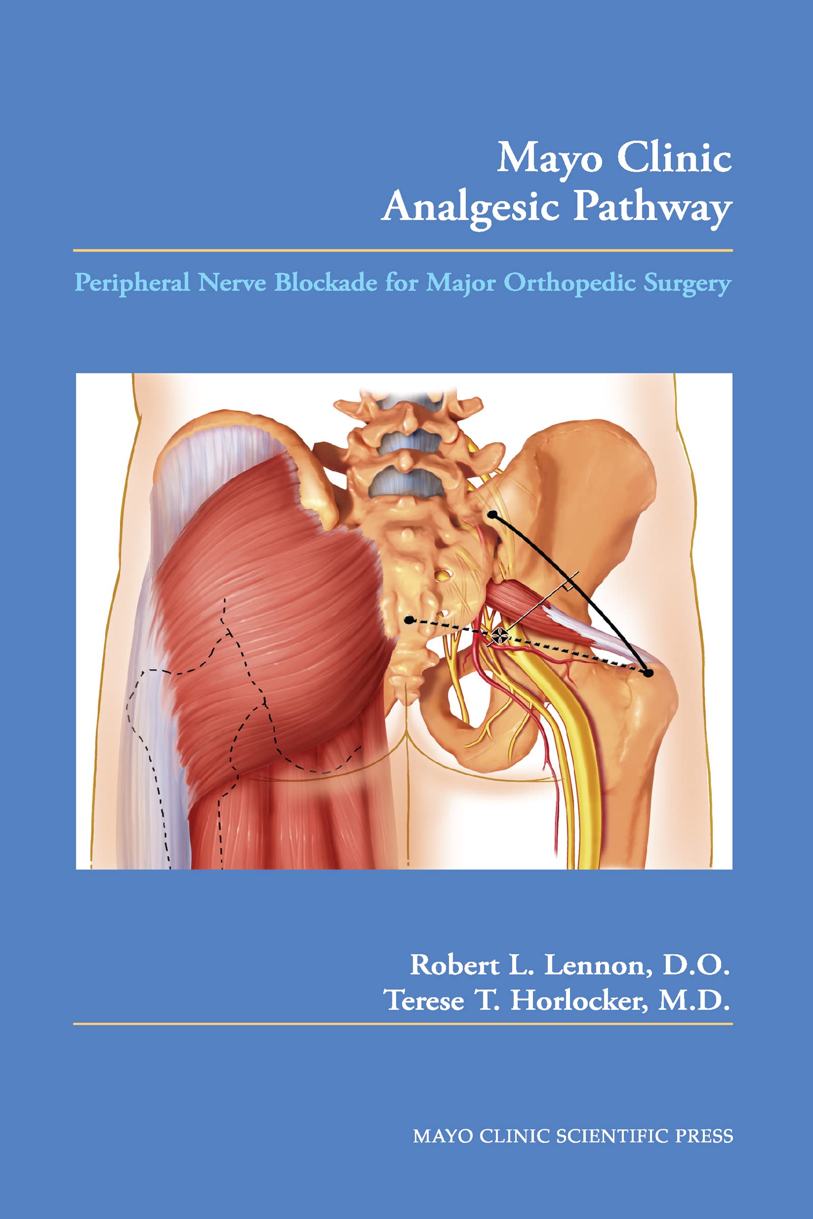 MAYO CLINIC ANALGESIC PATHWAY PERIPHERAL NERVE BLOCKADE FOR MAJOR