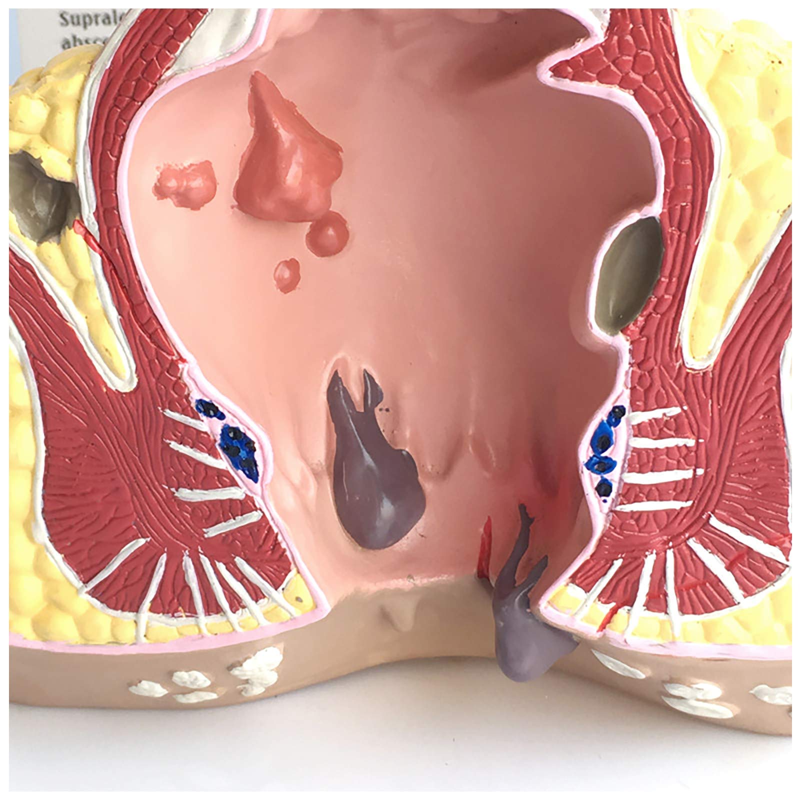 Modell Der Menschlichen Rektalen Pathologie, Modell Der Rektalen HäMorrhoidenpathologie, Modell Der Menschlichen Rektalen Anatomie, Medizinische Lehrmittel