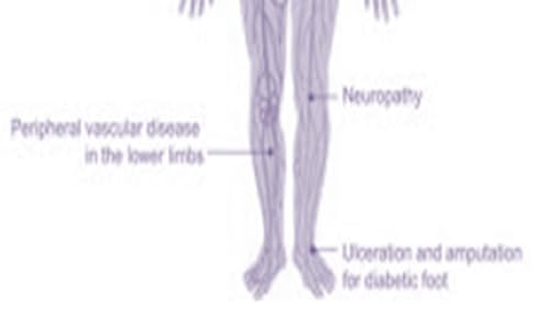 Diabetes 2 Top Foods to Help You Beat It Naturally – vue 4