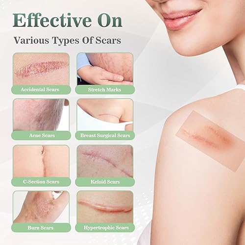 Miniatura 3 de Softxpp - Hojas de silicona de grado médico para cicatrices, cinta reutilizable para cicatrices de 1.6 x 60 pulgadas, rollo de 4.9 ft, tiras de