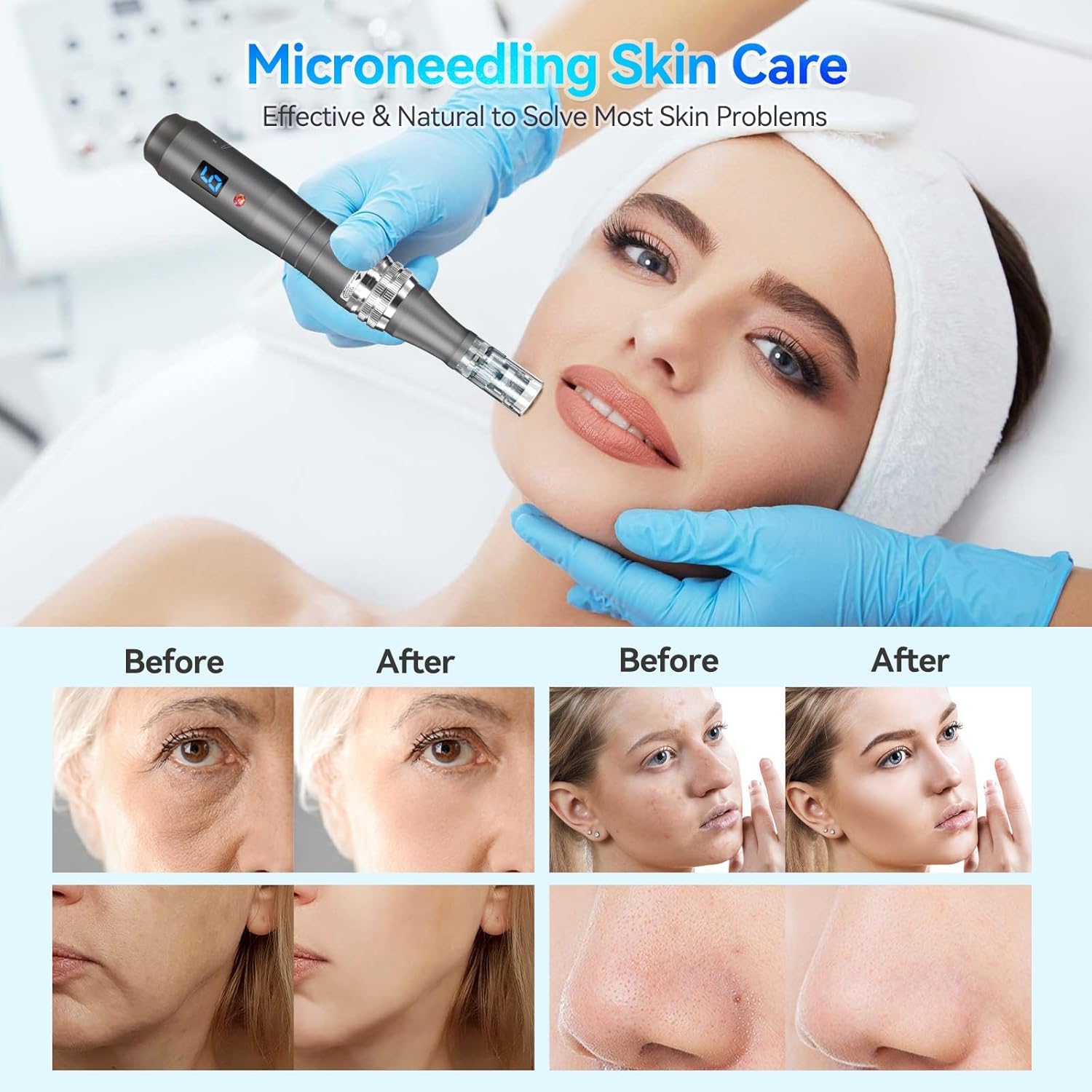 20pcs Nano Replacement Cartridges, Multiple Dermapen Microneedling Cartridges - Image 4