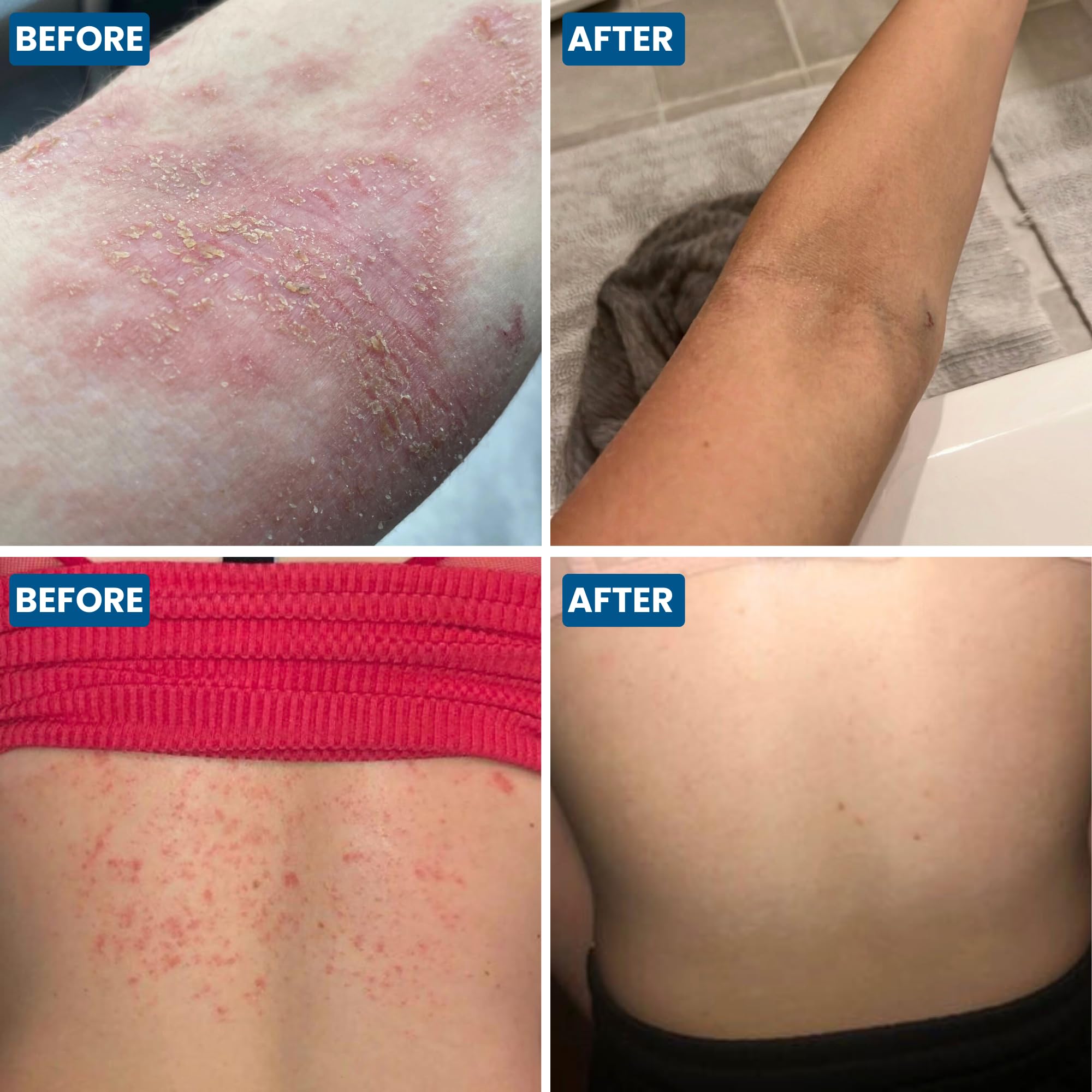 Grahams Natural Skin Therapy Body Oil for Very Dry Skin & Itch Relief, Moisturiser for Eczema-Prone Skin & Dermatitis - Image 4