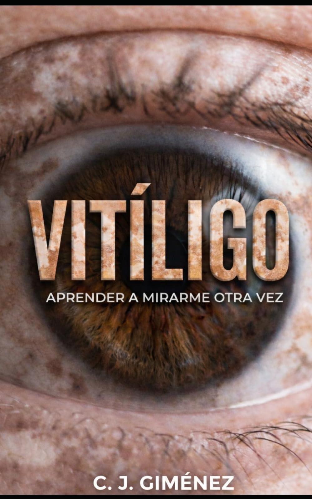 Vitíligo: Aprender a mirarme otra vez