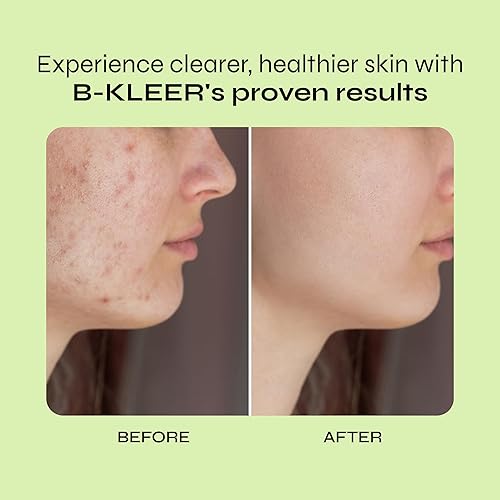 Miniatura 4 de A-Cute Derm B-Kleer Gel limpiador para el acné que purifica y protege tu piel de los poros obstruidos para todo tipo de piel (8 onzas)