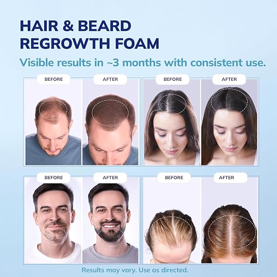 RootStim 5% Minoxidil Foam for men and women, Extra Strength Hair Regrowth Treatment for Thinning Hair and Hair Loss, Hair Follicle Health Thicker, Fuller Hair Growth Solution 6 FL.OZ