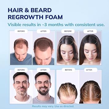 RootStim 5% Minoxidil Foam for men and women, Extra Strength Hair Regrowth Treatment for Thinning Hair and Hair Loss, Hair Follicle Health Thicker, Fuller Hair Growth Solution 6 FL.OZ