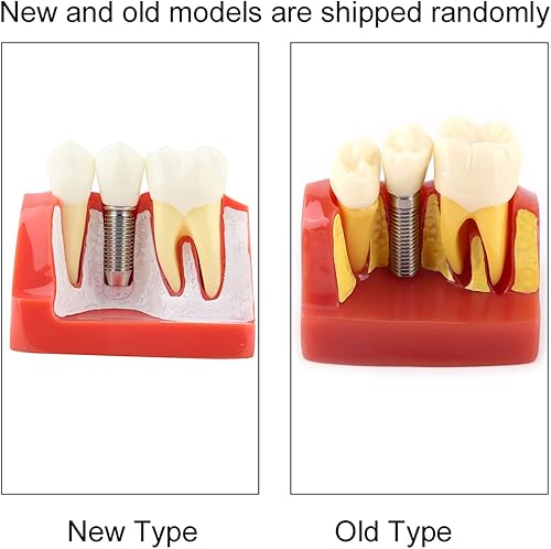 Miniatura 4 de Demostración de resina Modelo de diente educativo Análisis de implantes Puente de corona para la escuela del dentista