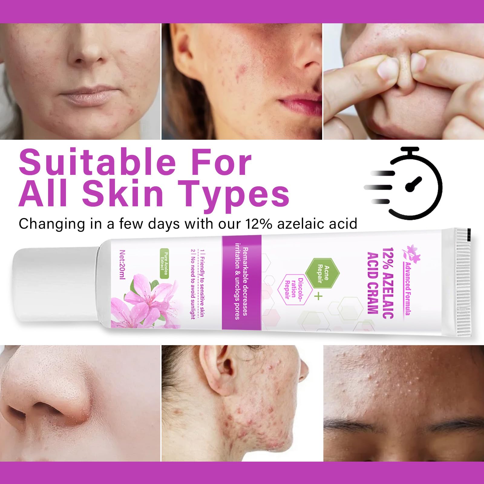 Siero Al 12% Di Acido Azelaico, Combatte Acne E Brufoli, Brufoli Invisibili, Libera I Pori, Riduce Significativamente L'Irritazione, Siero Antiacne Per La Pelle, 1 Oz