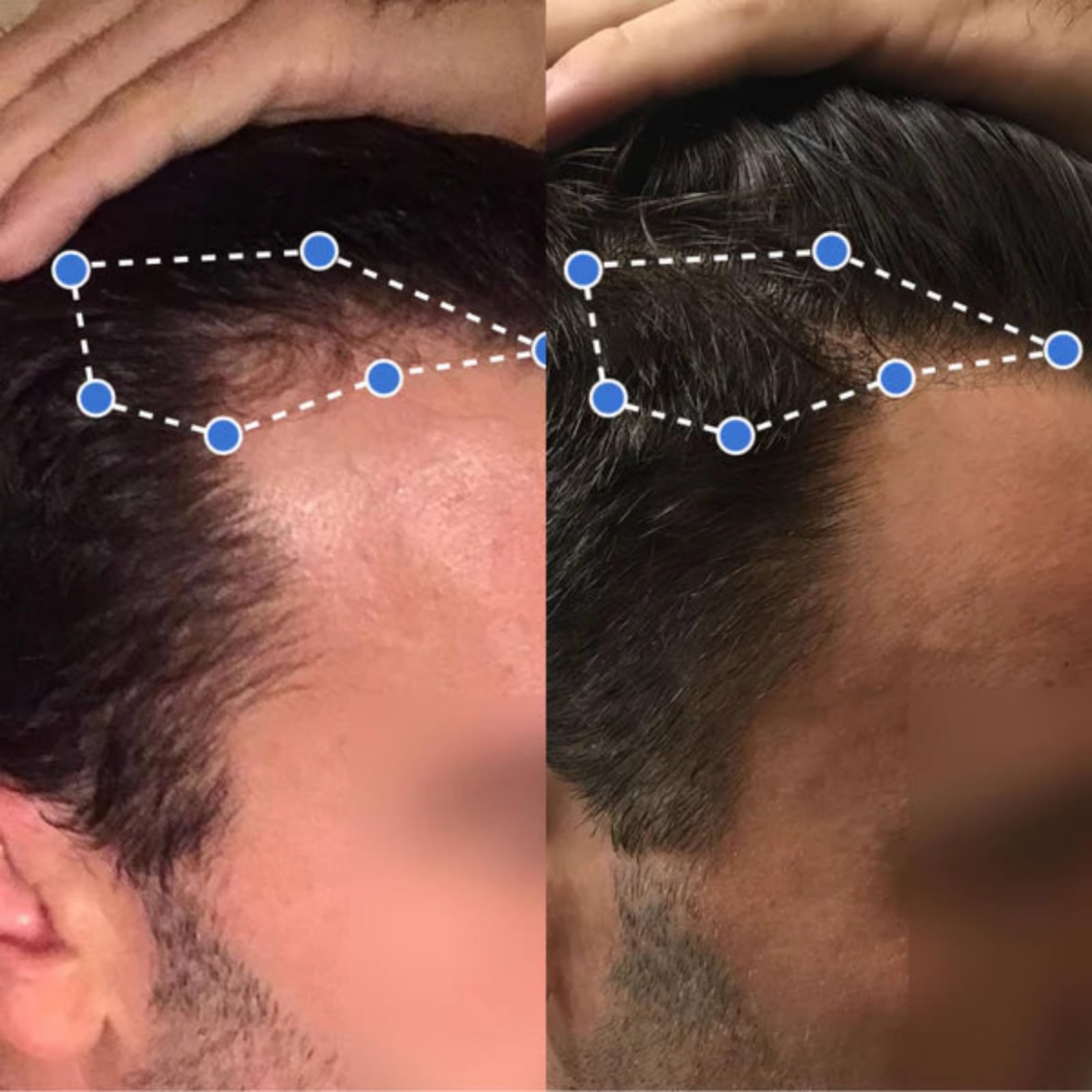 Depura - Siero Rigenerante per Capelli，Siero per Capelli Roll On al Rosmarino, Anti-Caduta e Crescita Capillare, Nutre Cuoio Capelluto e Rafforza Radici