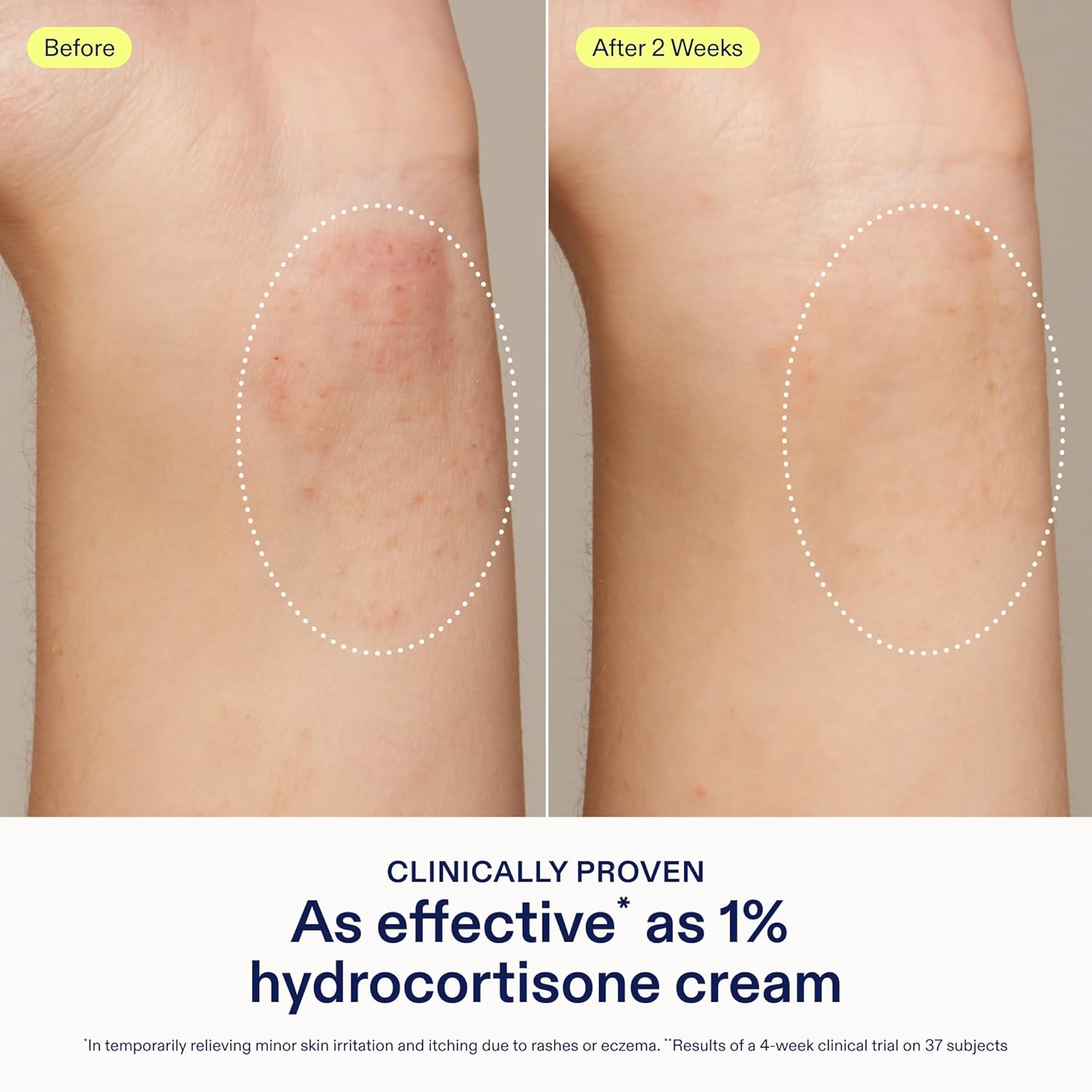 Skinfix Dermatitis Relief Balm with 5% Colloidal Oatmeal & Vitamin E - 1.7 fl oz - Proven Effective as 1% Hydrocortisone - Relieves Eczema & Itch - Accepted by the National Eczema Association