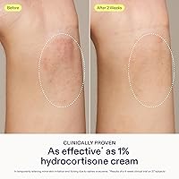 Vista 3 de Skinfix Bálsamo para aliviar la dermatitis, 1.7 onzas líquidas, probado como hidrocortisona al 1%, alivia el eccema y la picazón, aceptado por