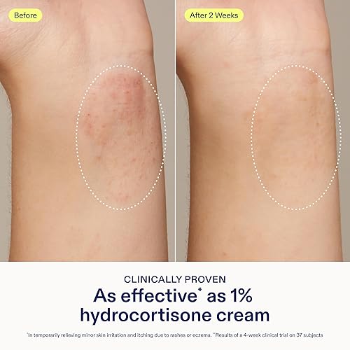 Miniatura 3 de Skinfix Bálsamo para aliviar la dermatitis, 1.7 onzas líquidas, probado como hidrocortisona al 1%, alivia el eccema y la picazón, aceptado por la