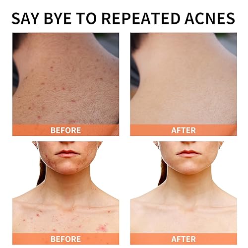 Miniatura 5 de Tratamiento para el acné para la cara crema para el acné con ácido salicílico crema para el acné para adolescentes y adultos crema hidratante