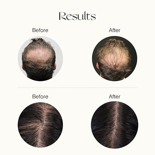 Miniatura 6 de Nourish Mantra Suero avanzado para el crecimiento del cabello, 1.7 fl oz, con Redensyl, Anagain, Procapil y Capilia Longa para el control de caídas