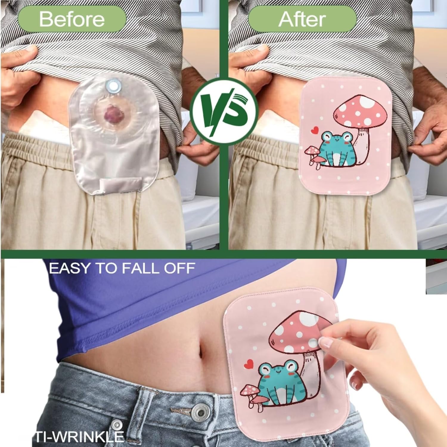 Rnyleeg Ostomy Supplies for Kids Cute Frog Colostomy Bag Covers for Women Washable Ostomy Drainable Pouch Ileostomy Bags with Closure 4 Piece