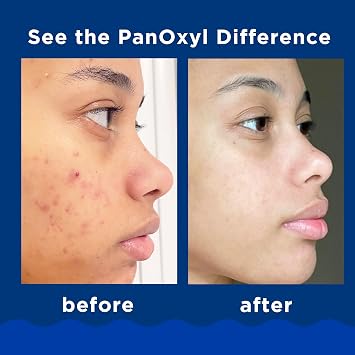 Lemisol Feminine Wash 16 Oz & PanOxyl 10% Benzoyl Peroxide 5.5 Oz Acne Foaming Face Wash