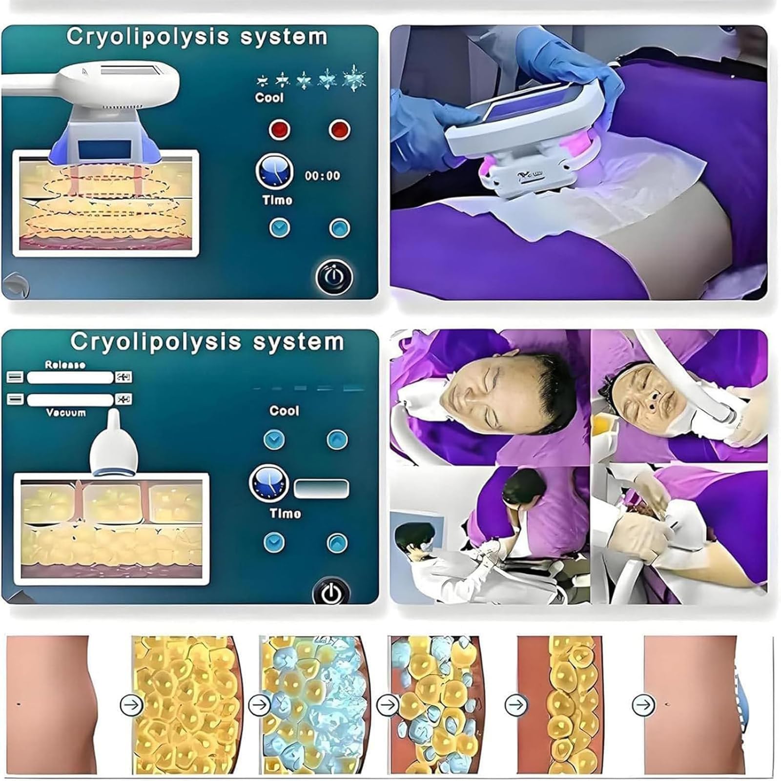 Urządzenie do usuwania tkanki tłuszczowej metodą CoolSculpting – aparat do kriolipolizy i lipolizy, wyszczuplania oraz modelowania sylwetki, wyposażony w 3 głowice