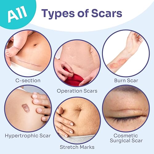 Miniatura 3 de Conkote Cintas de silicona para cicatrices (rollo de 1.6 x 120 pulgadas, 9.8 ft), tratamientos para reducir cicatrices, eliminación de