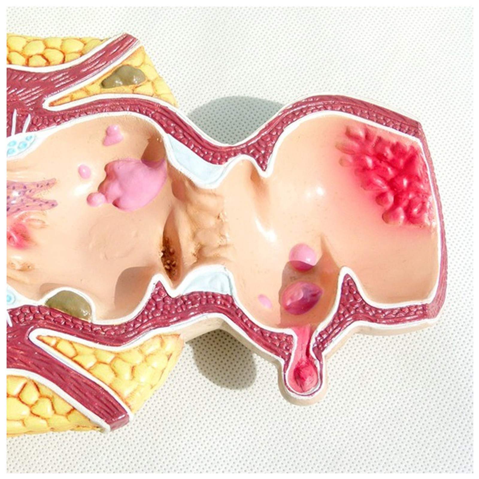 Modell Der Menschlichen Rektalen Pathologie, Modell Der Rektalen HäMorrhoidenpathologie, Modell Der Menschlichen Rektalen Anatomie, Medizinische Lehrmittel