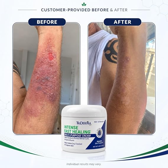 TriDerma Intense Fast Healing Cream for Sores, Cuts, Scrapes, Cracked Hands, Rashes and Hard-to-Heal Skin Irritations, Therapeutic Skin Care Pack of 4