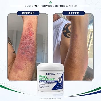 TriDerma Intense Fast Healing Cream for Sores, Cuts, Scrapes, Cracked Hands, Rashes and Hard-to-Heal Skin Irritations, Therapeutic Skin Care Pack of 4